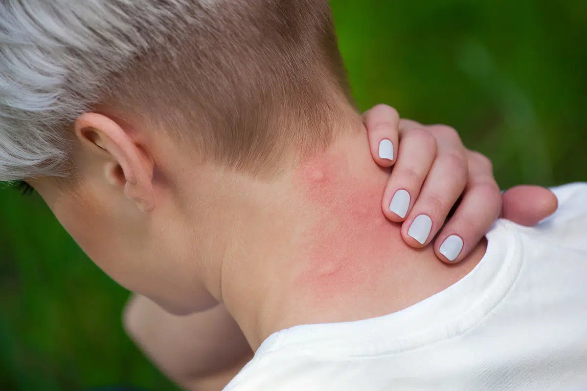 Mosquito Bite in Lady neck